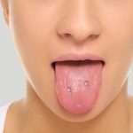 home remedies for blisters on tongue