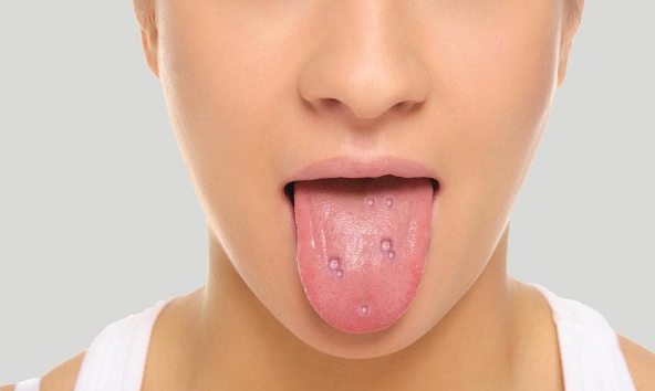 home remedies for blisters on tongue