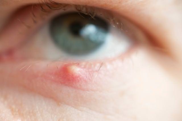 home remedies for eyelid cysts