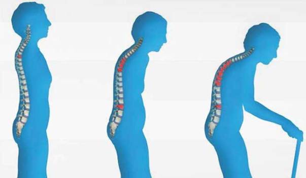 home remedies for osteoporosis treatment