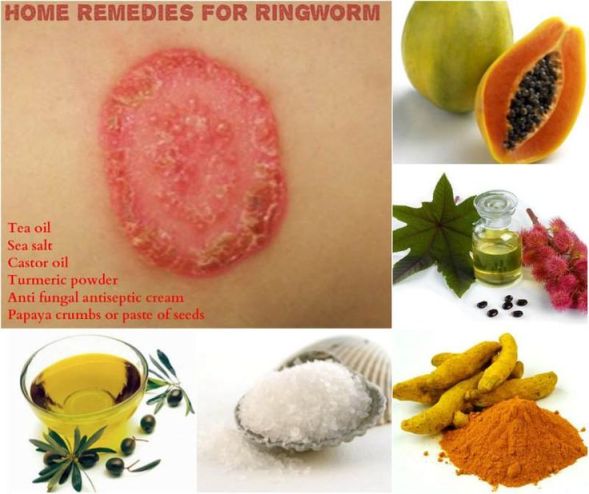 home remedies to get rid of ringworm