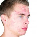 how to get rid of acne fast and naturally