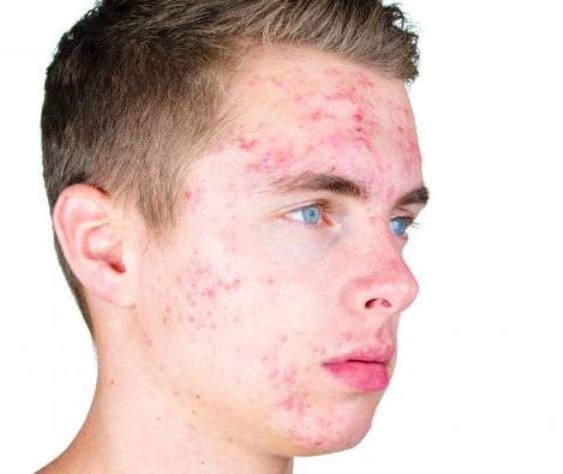 how to get rid of acne fast and naturally