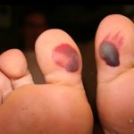 how to get rid of blood blister
