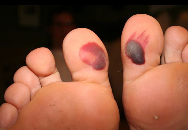 how to get rid of blood blister