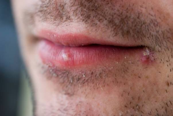 how to get rid of cold sores overnight