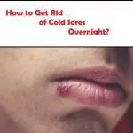 How to Get Rid of Cold Sores Overnight and Fast? how to get rid of cold sores overnight