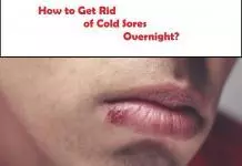 how to get rid of cold sores overnight