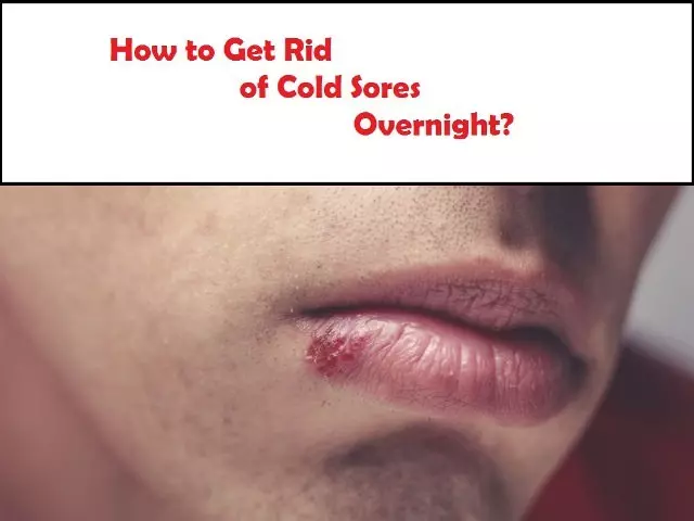 how to get rid of cold sores overnight