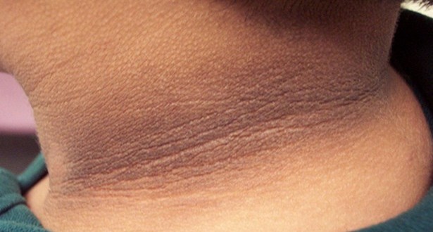 how to get rid of dark skin on neck