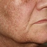 how to get rid of hyperpigmentation