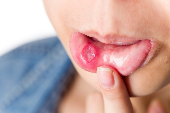 how to get rid of mouth ulcers