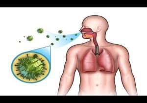 How to Get Rid of Pneumonia at Home?
