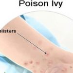 how-to-get-rid-of-poison-ivy