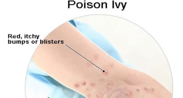 how-to-get-rid-of-poison-ivy
