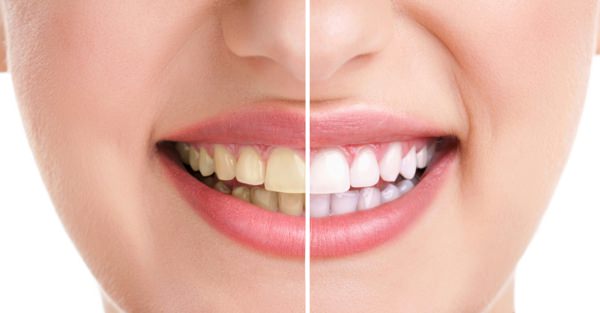 how to get whiter teeth