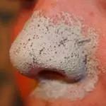 how to remove blackheads