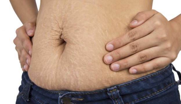 how to remove stretch marks