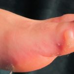 how to treat a foot blister