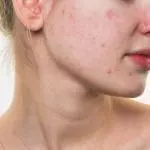 how to treat acne