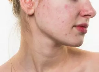 How to Treat Acne? – Home Remedies For Acne Treatment how to treat acne