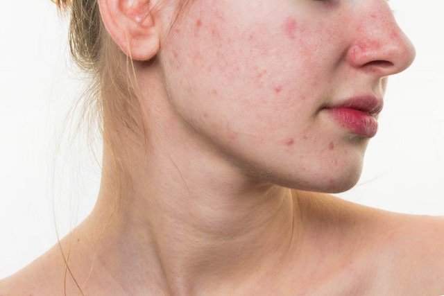 how to treat acne