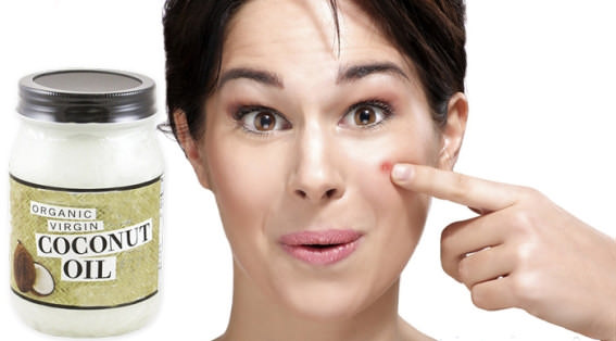 Coconut oil for acne