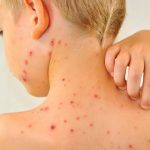 Home Remedies for Chicken Pox