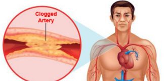 Home Remedies for Clogged Arteries