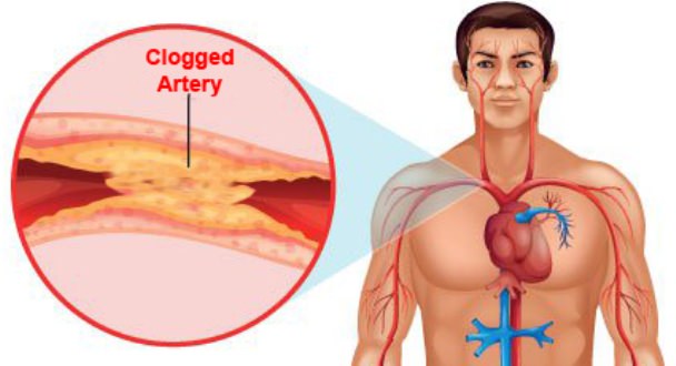 Home Remedies for Clogged Arteries