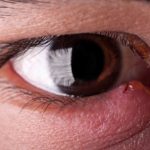 Home Remedies for Eye Stye Treatment