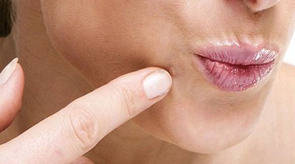 Home Remedies for Facial Warts Treatment Treat Facial Warts
