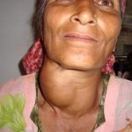 Home Remedies for Goiter