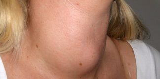 Home Remedies for Goiter
