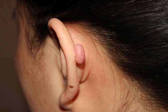 Home Remedies for Keloids Removal
