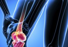 Home Remedies for Osteoarthritis