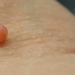 Home Remedies for Skin Tag Removal