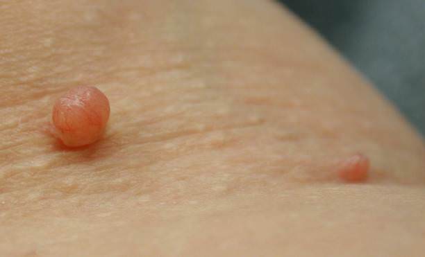 Home Remedies for Skin Tag Removal