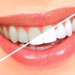 Home Remedies for Teeth Whitening