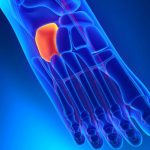 Home remedies for bone spur