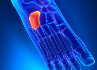 Home remedies for bone spur