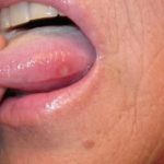 Home remedies to treat blisters on tongue