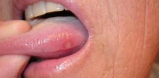 Home remedies to treat blisters on tongue