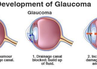 Home remedies to treat glaucoma