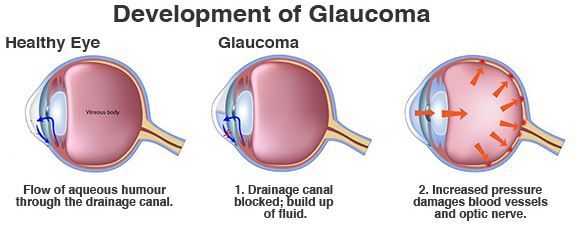 Home remedies to treat glaucoma
