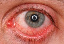 Home remedies to treat eye infection