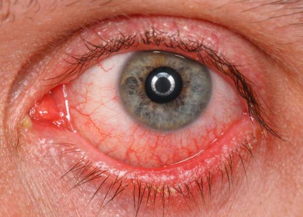 Home remedies to treat eye infection