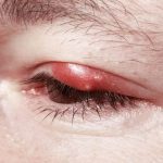 How to Cure a Stye fast and naturally