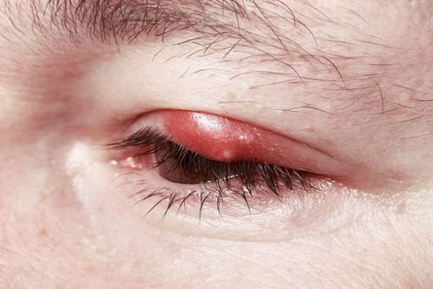 How to Cure a Stye fast and naturally