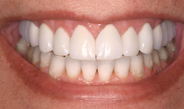 How to Get Rid of Gingivitis Fast at Home